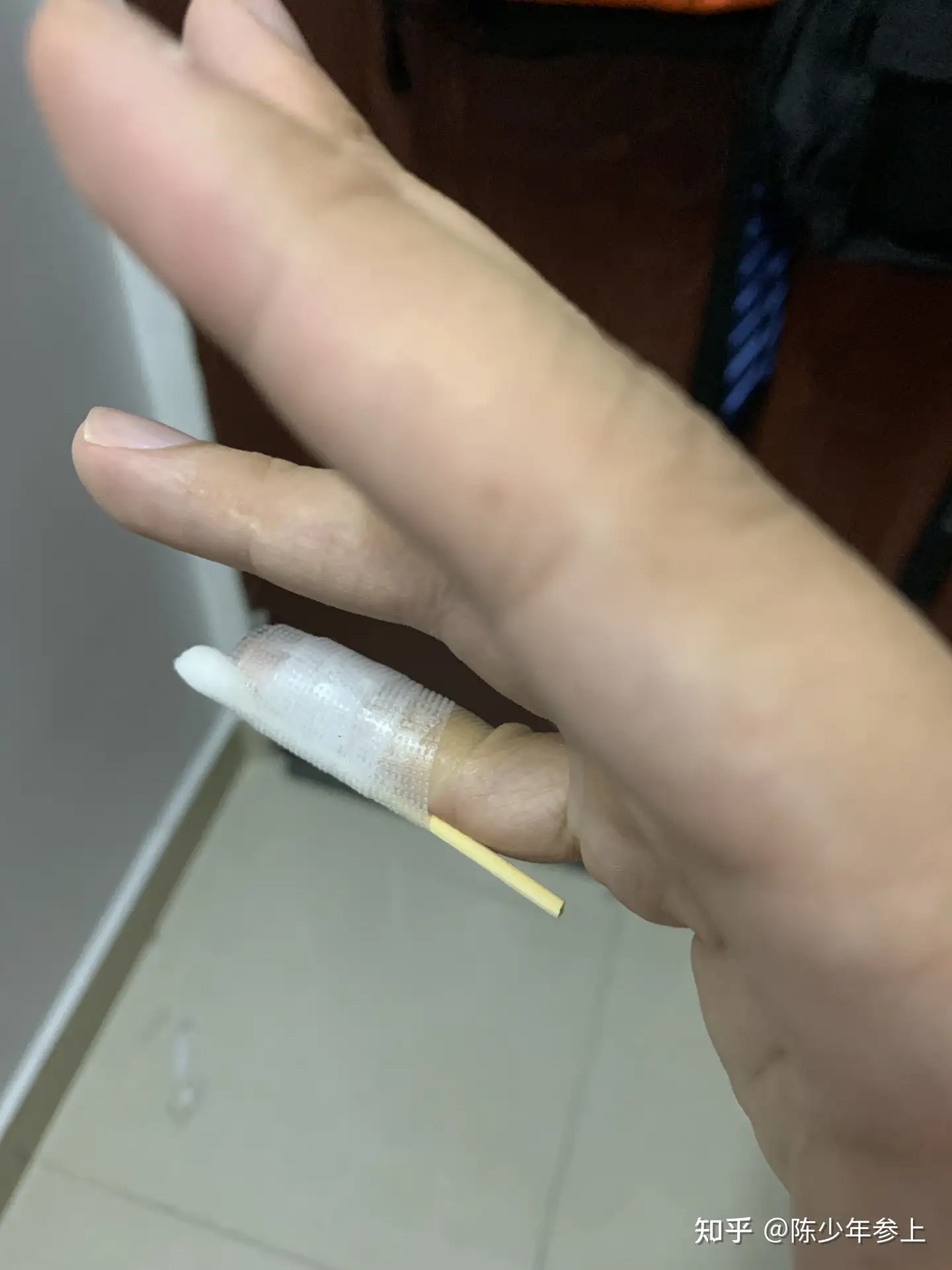 右小指伸肌腱断裂 锤状指 知乎