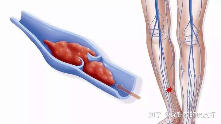 腔静脉滤器深静脉血栓患者的血管警察