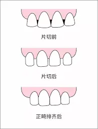 片切适合牙齿轻度拥挤的患者,和牙冠形态不美观的患者