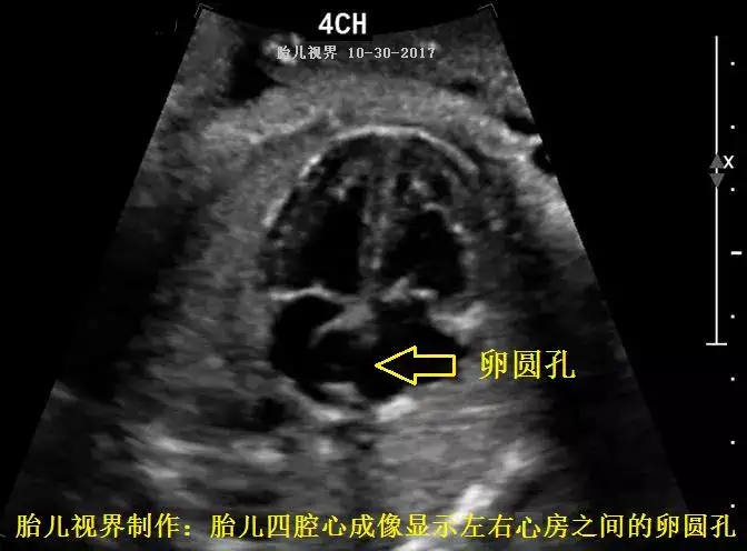 超声波不能检查胎儿的哪些先天性情况？ - 知乎