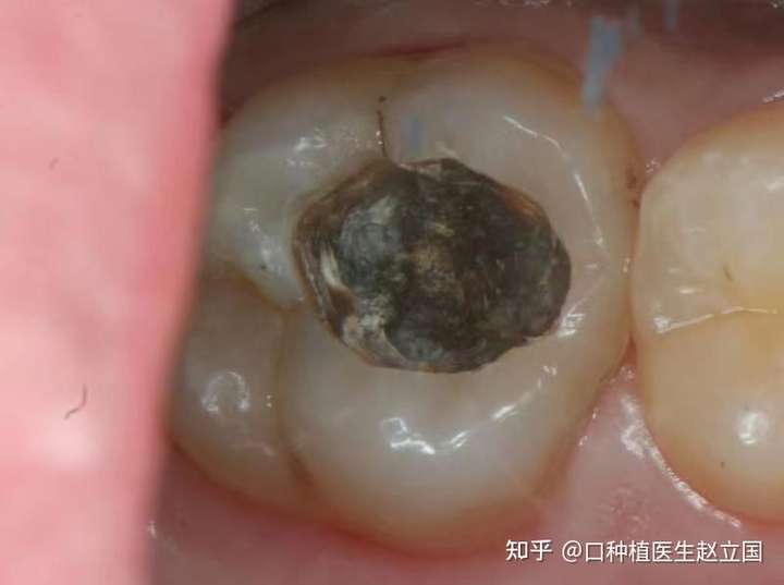 補個牙嘛,又不是什麼急症