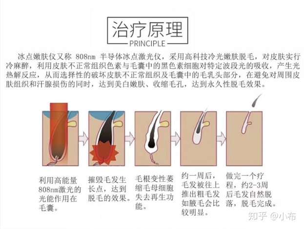 808半导体激光冰点无痛脱毛仪