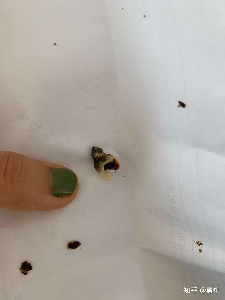 耳屎能大到什么程度?