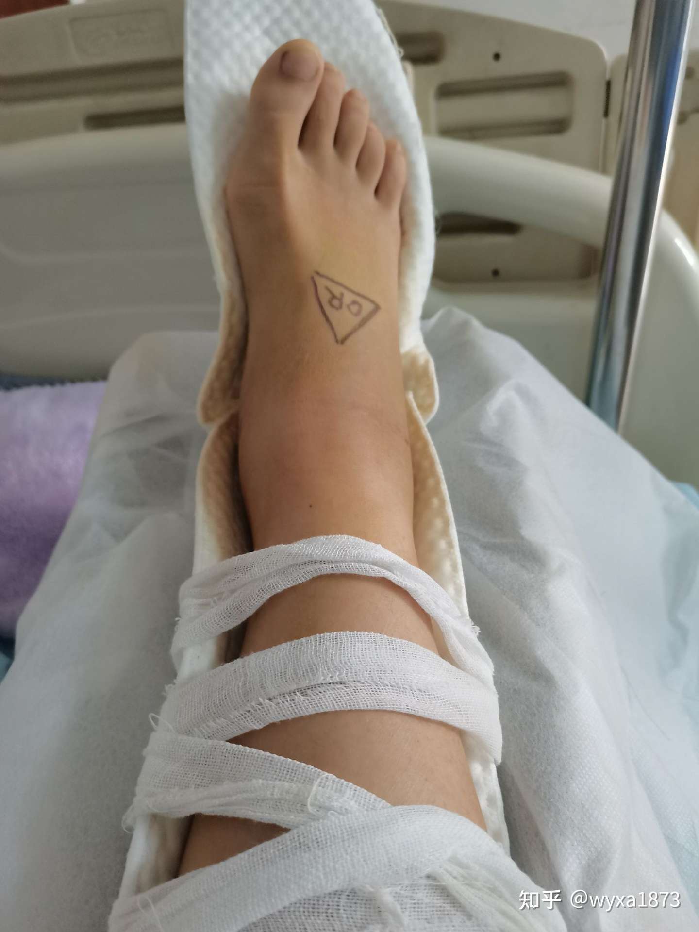 脚踝骨折及恢复过程记录 知乎