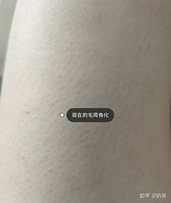 激光脱毛能治疗鸡皮肤吗(激光脱毛能治疗鸡皮肤吗图片) 激光脱毛能治疗鸡皮肤吗(激光脱毛能治疗鸡皮肤吗图片)