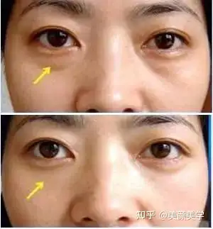 泪沟颜值杀手年纪大了变苦相如何塑造好命颜