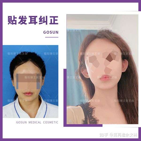 案例故事 贴发耳显脸大 小姐姐做了赵丽颖同款耳朵后脸也变小了 知乎