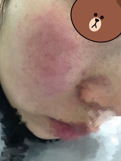 这是我换季过敏最严重的时候