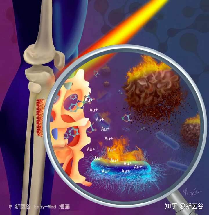 推荐存图系列五肿瘤光热疗法