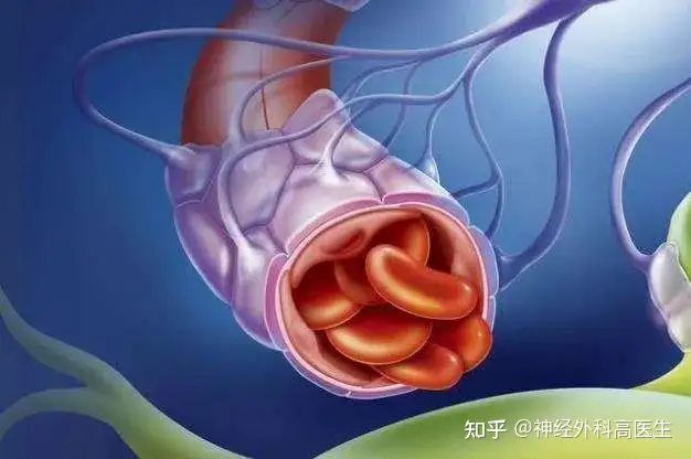 后瓜坏获老仑椎燃蜘赐窄、傀筐下动脉肛窄罢虹陶治猾桃保播扒若？(图2)