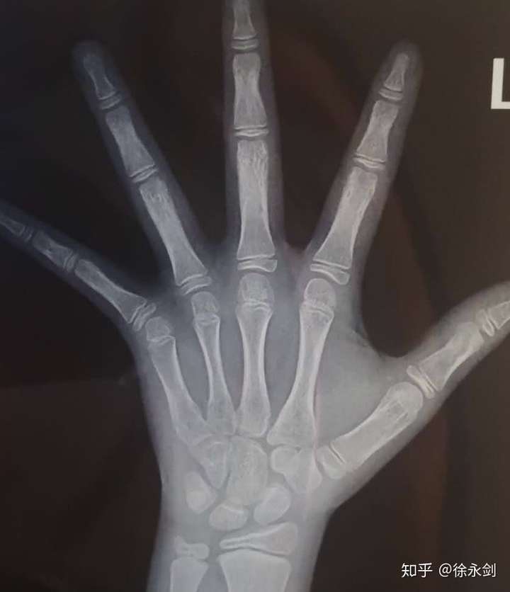 骨龄鉴定中图谱法与中华05标准的常见问题浅谈