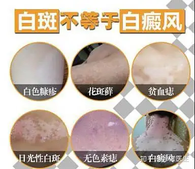 其实,面部白斑可能提示的疾病有很多,包括白癜风,炎症后色素减退,无