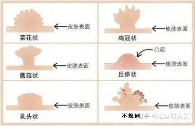 你知道女性尖锐湿疣初期症状都有哪些吗? - 知乎