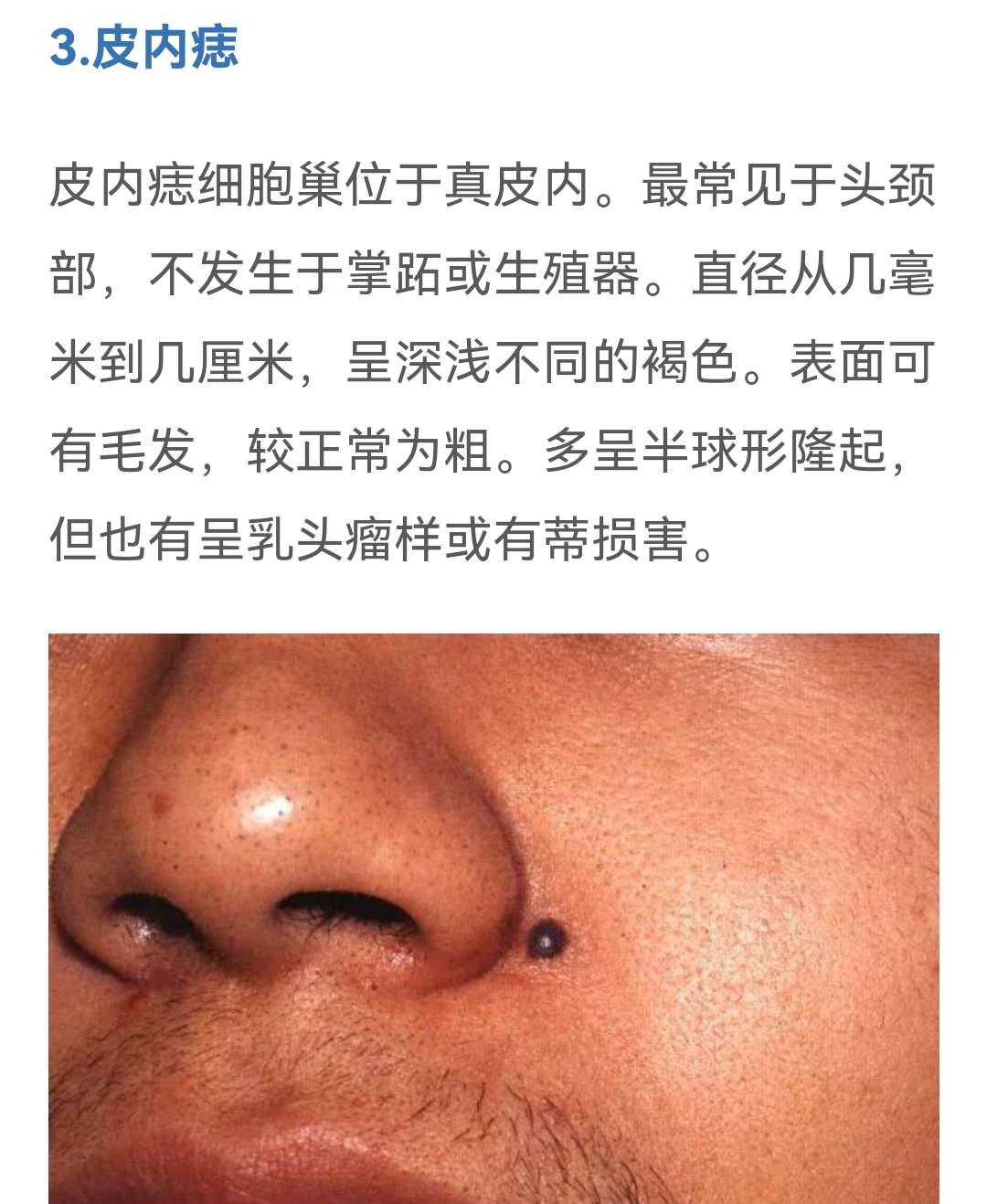 卉卉圆 的想法: 痣的分类: 1交界痣 2混合痣 3皮内痣 - 知乎