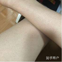 腿上鸡皮肤很痒是什么原因(腿上很痒,抓完都是鸡皮肤的感觉)