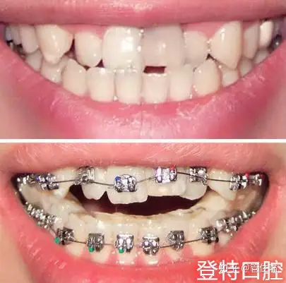 牙齿开颌 咬合关节响就决定矫正牙齿. - 知乎