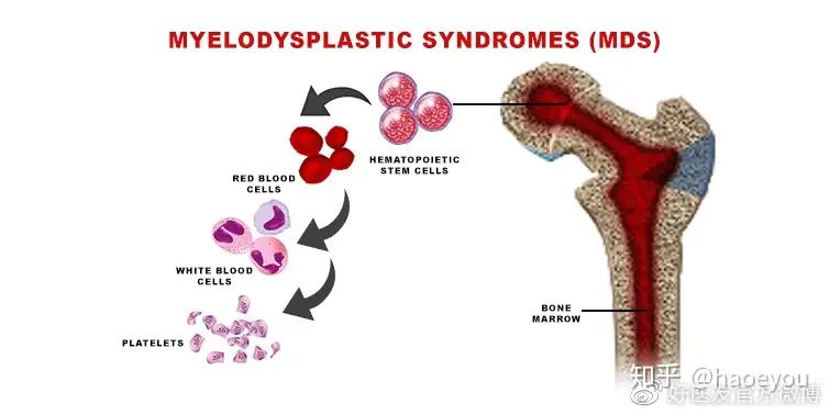 总缓解率91%！新疗法有望破解高危MDS治疗难题- 知乎