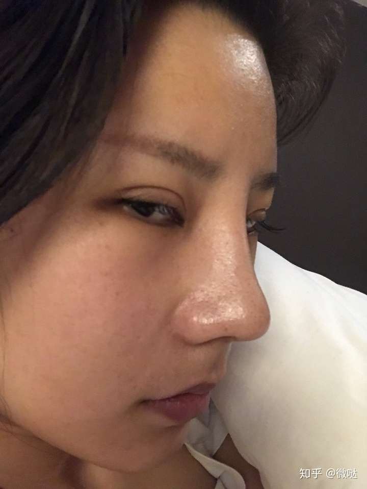 硅胶隆鼻25天山根很高后期能消下去吗?