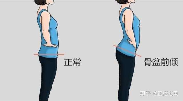 举个例子来说,常见的像骨盆前移和骨盆前倾就很容易引起膝超伸现象.