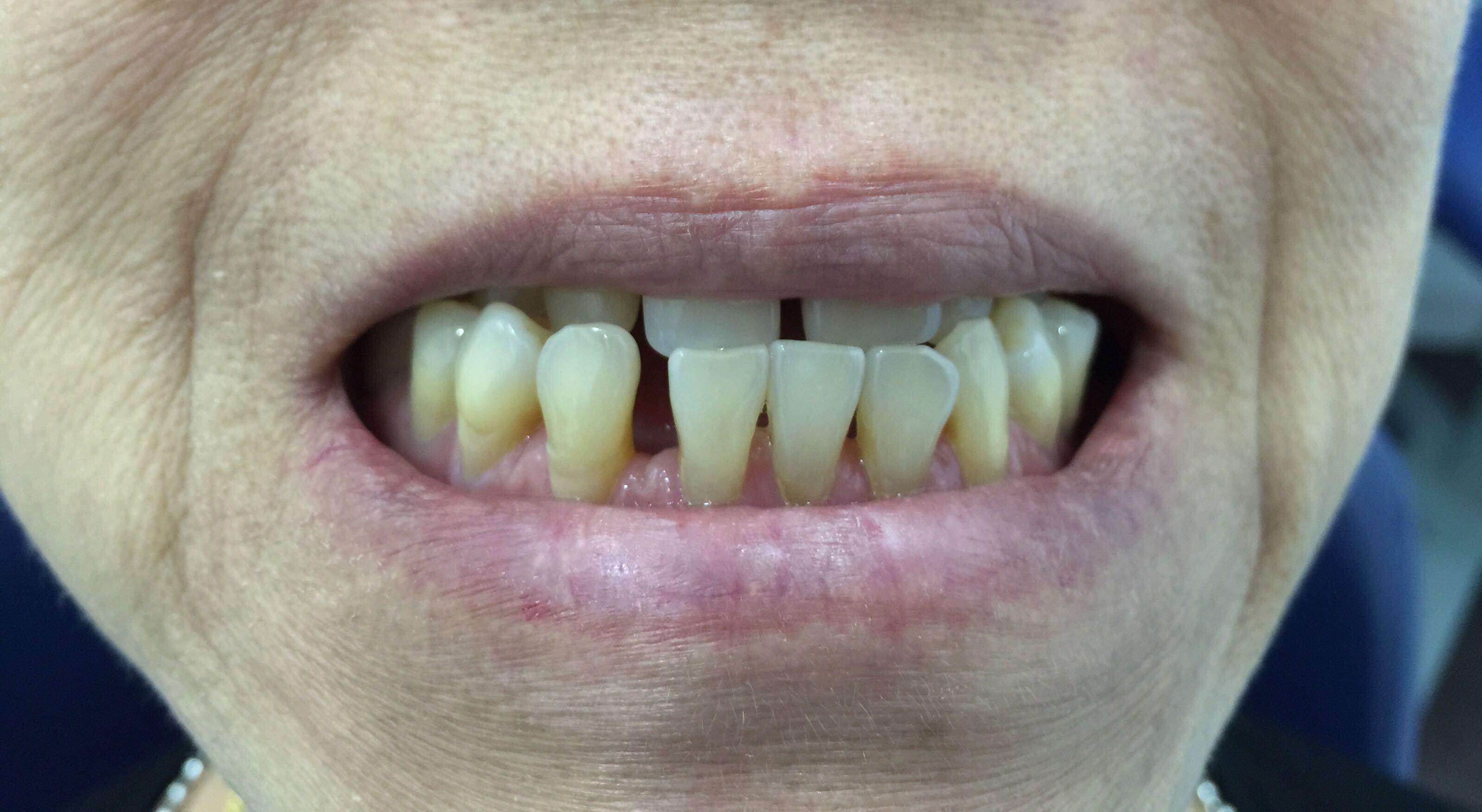 两颗门牙之间有缝拍照都不敢笑了如何修复有没有牙医帮助