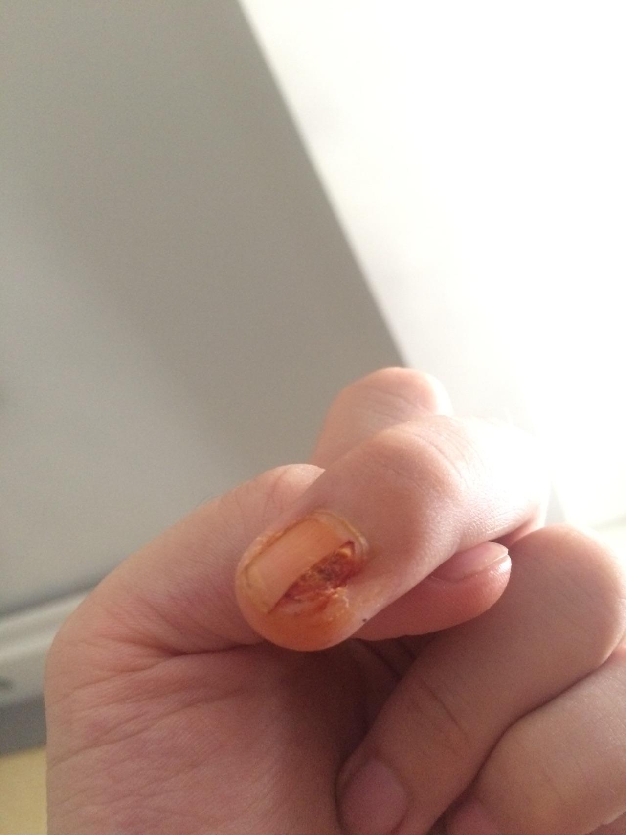 拔指甲是什么样的体验?很疼么? - 知乎