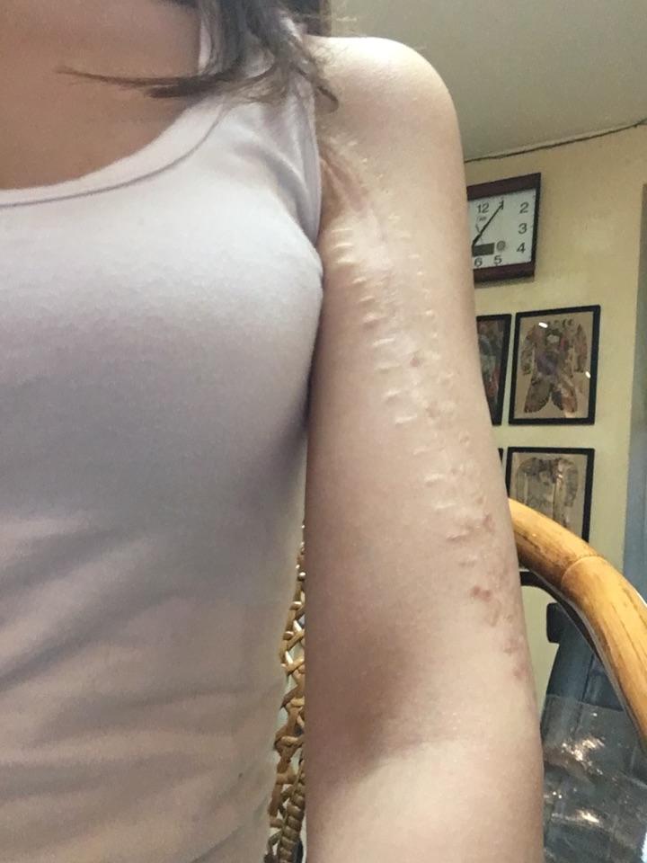 我是执小念的分割线—————— 15岁时患上了尤文肉瘤