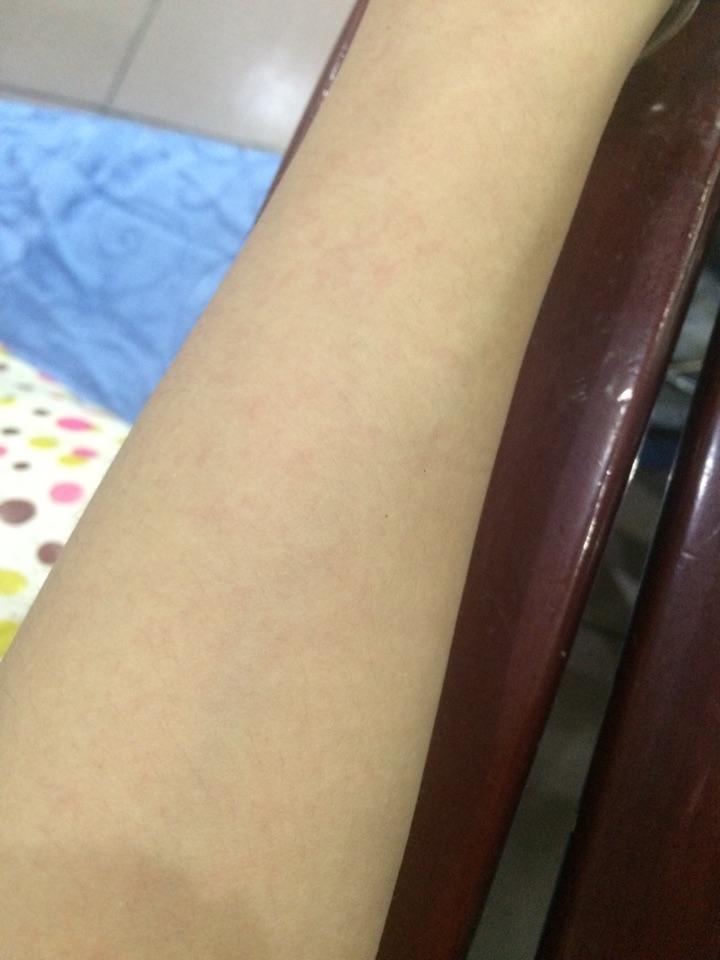 为什么静脉注射阿奇霉素对血管刺激这么严重