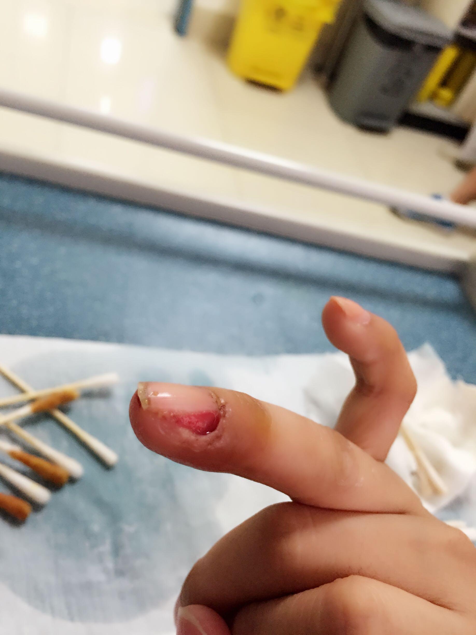 拔指甲是什么样的体验很疼么