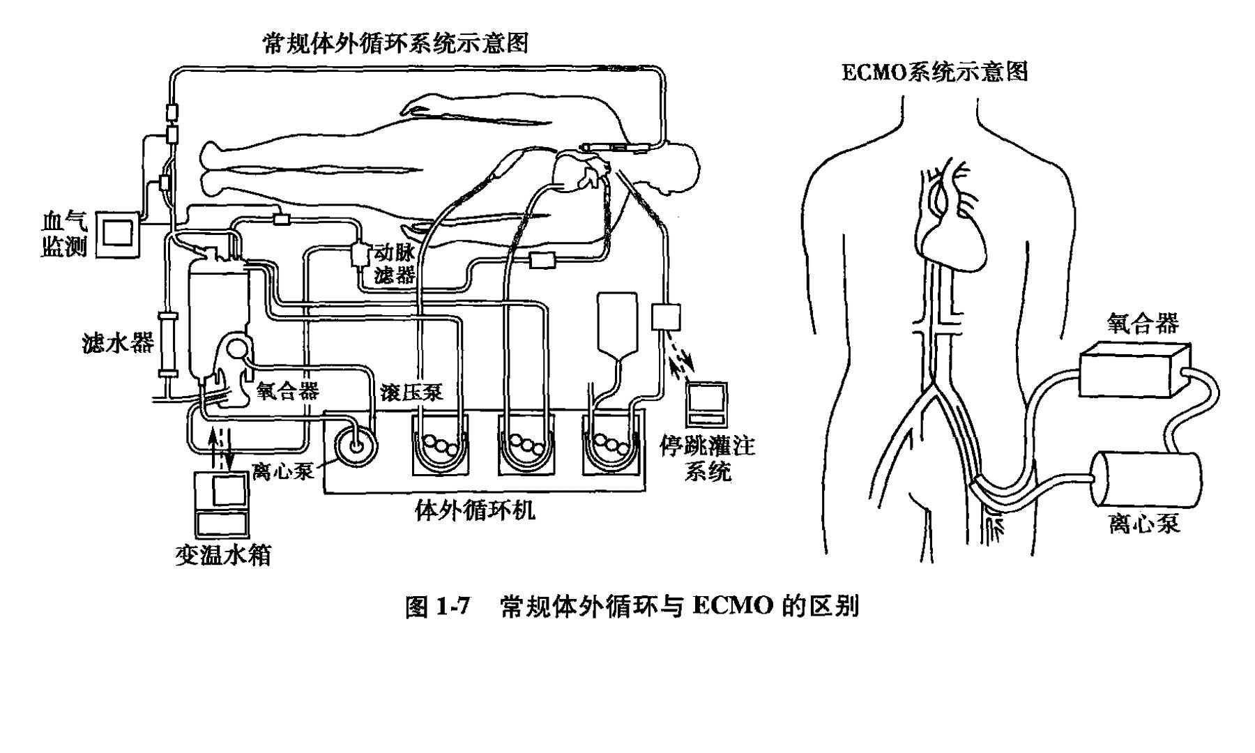 体外膜肺氧合(ecmo)的原理是什么,较之于传统体外循环优势体现在哪些