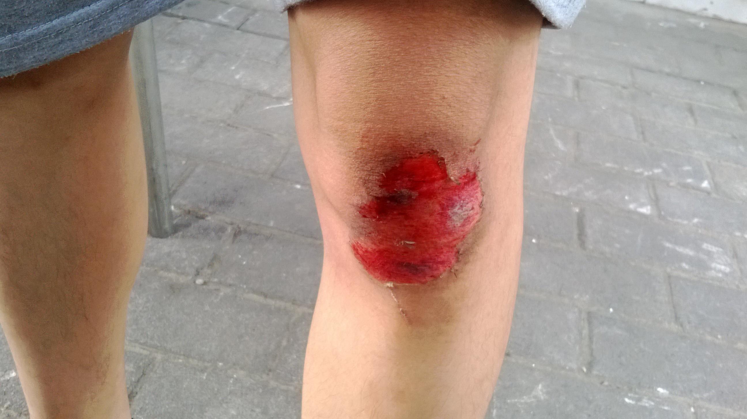 皮肤创伤擦伤的正确治疗方法是什么? - 知乎