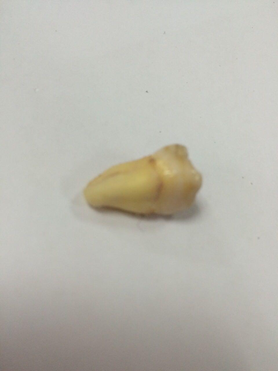 拔智齿有多痛? - 倪倪的回答 - 知乎