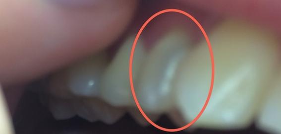 浅龋齿一定要补吗