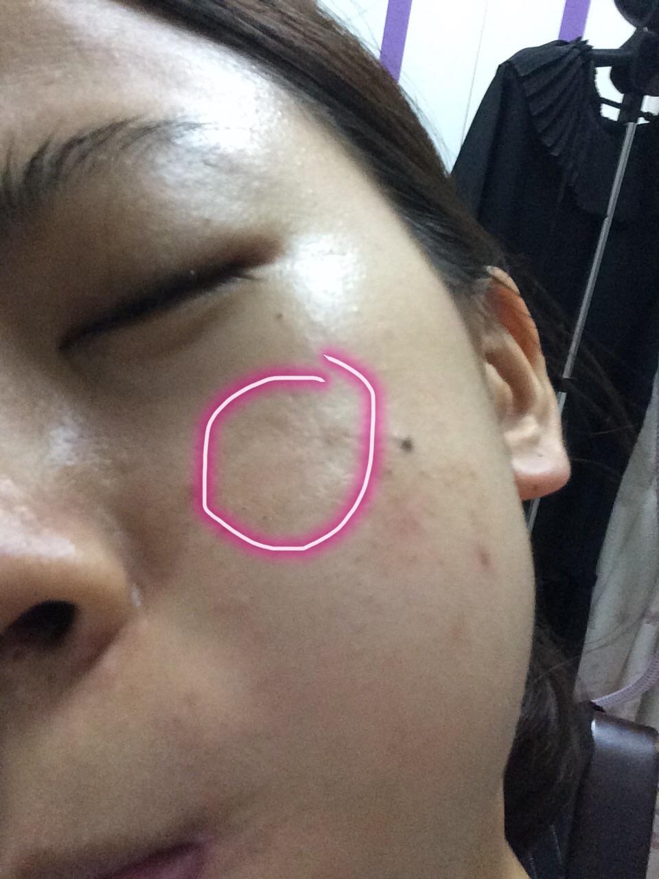 皮肤脸颊有块变黑了怎么会这样会退吗