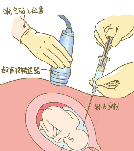 多少周做羊穿或者无创 9505114104d0fb88228e7ac60be2d24c_1200x500.jpg