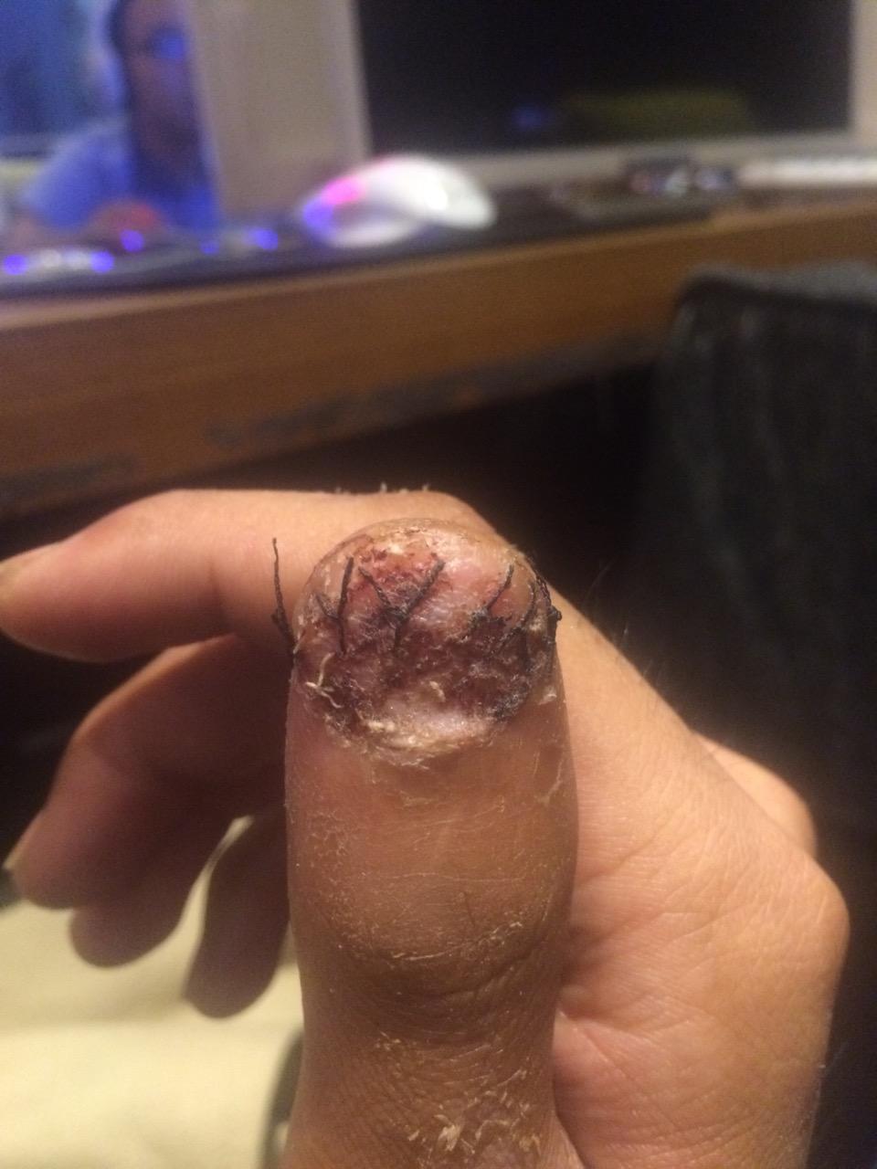 拔指甲是什么样的体验很疼么