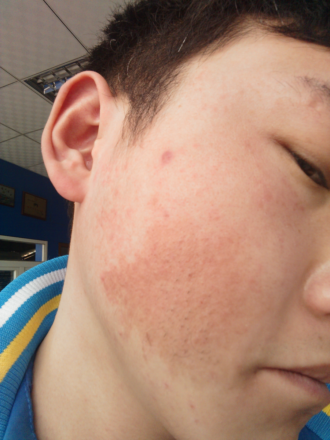 鸡皮肤长在脸上怎么办