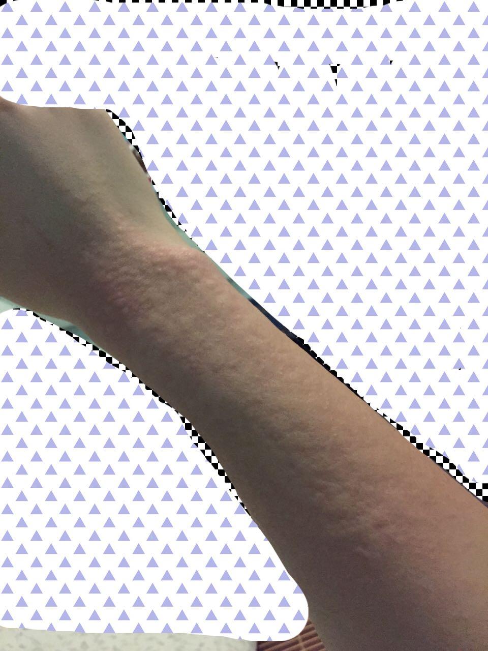 在美甲店蜜蜡脱毛严重过敏,该如何维权?