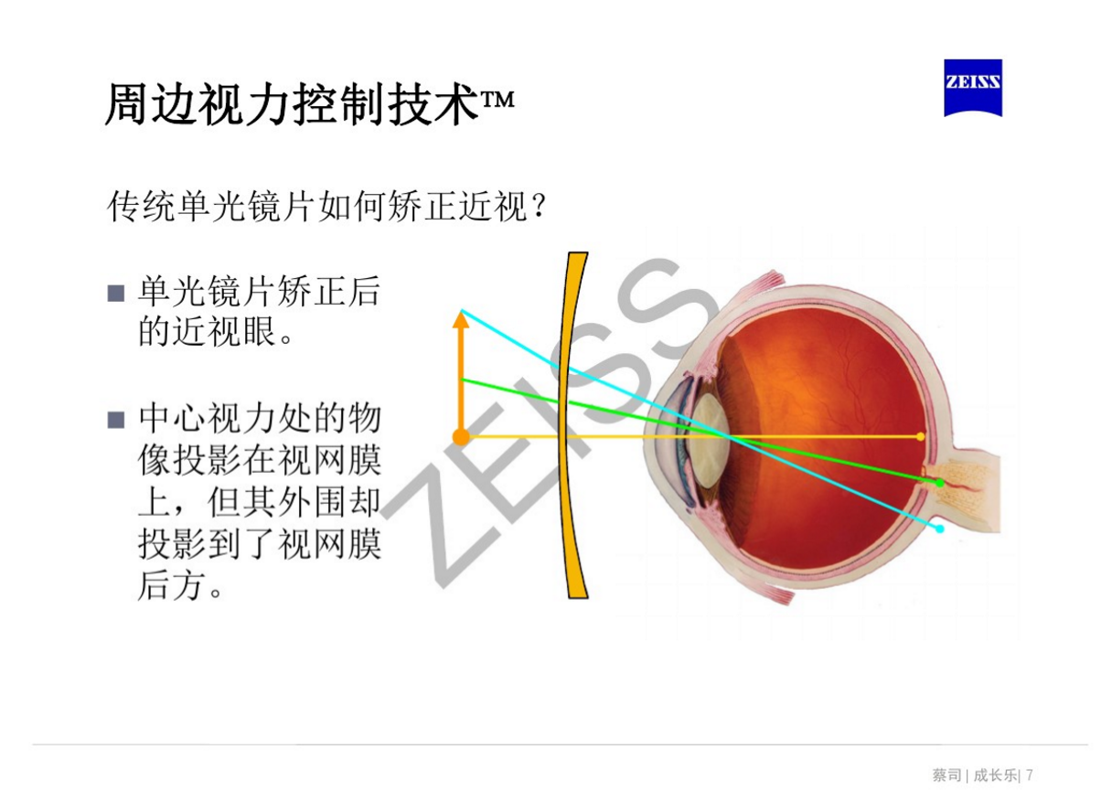 离焦镜是什么原理,真的可以缓解近视吗? - 知乎
