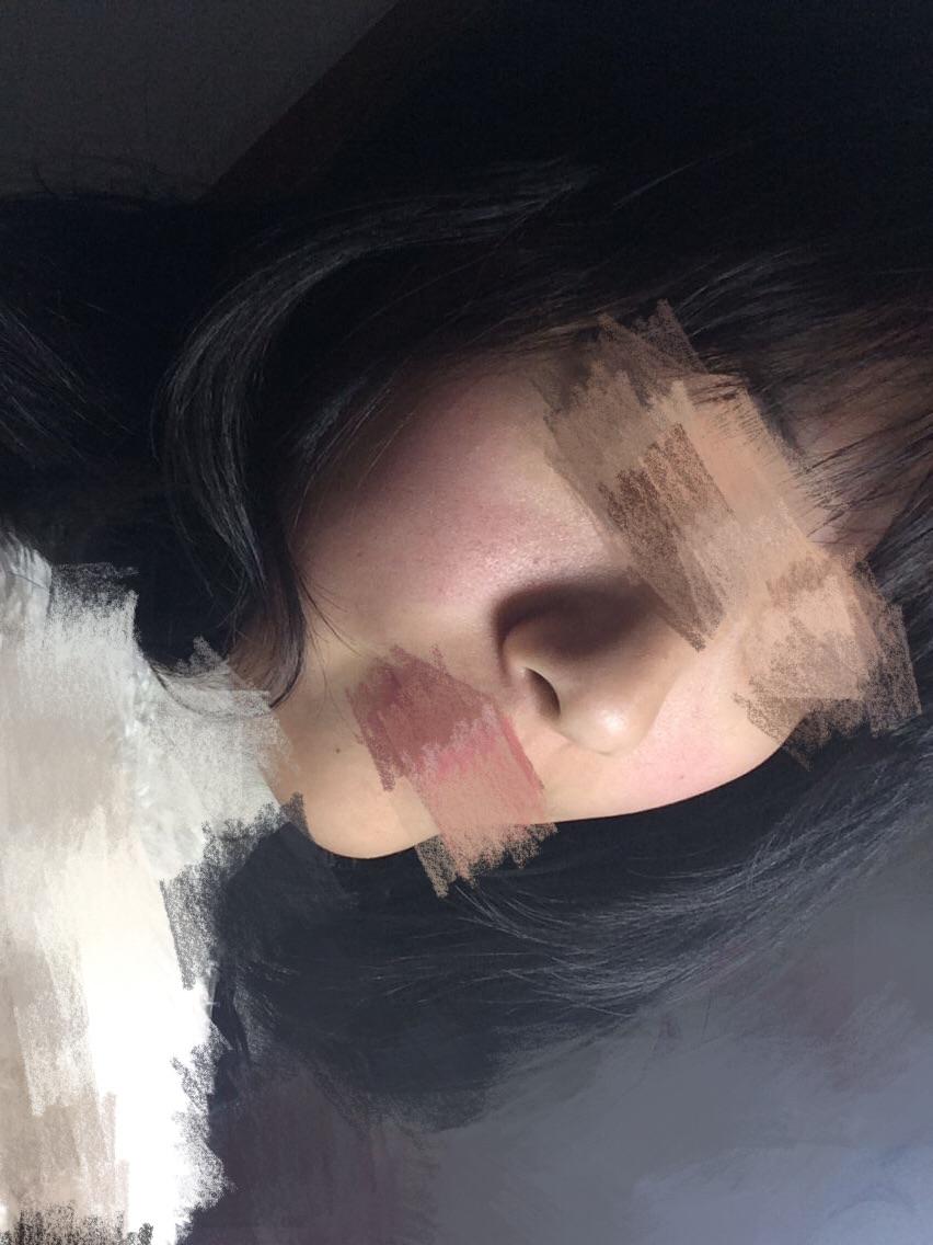 额头上的痘痘和鼻子上的黑头怎么办? - 美容护