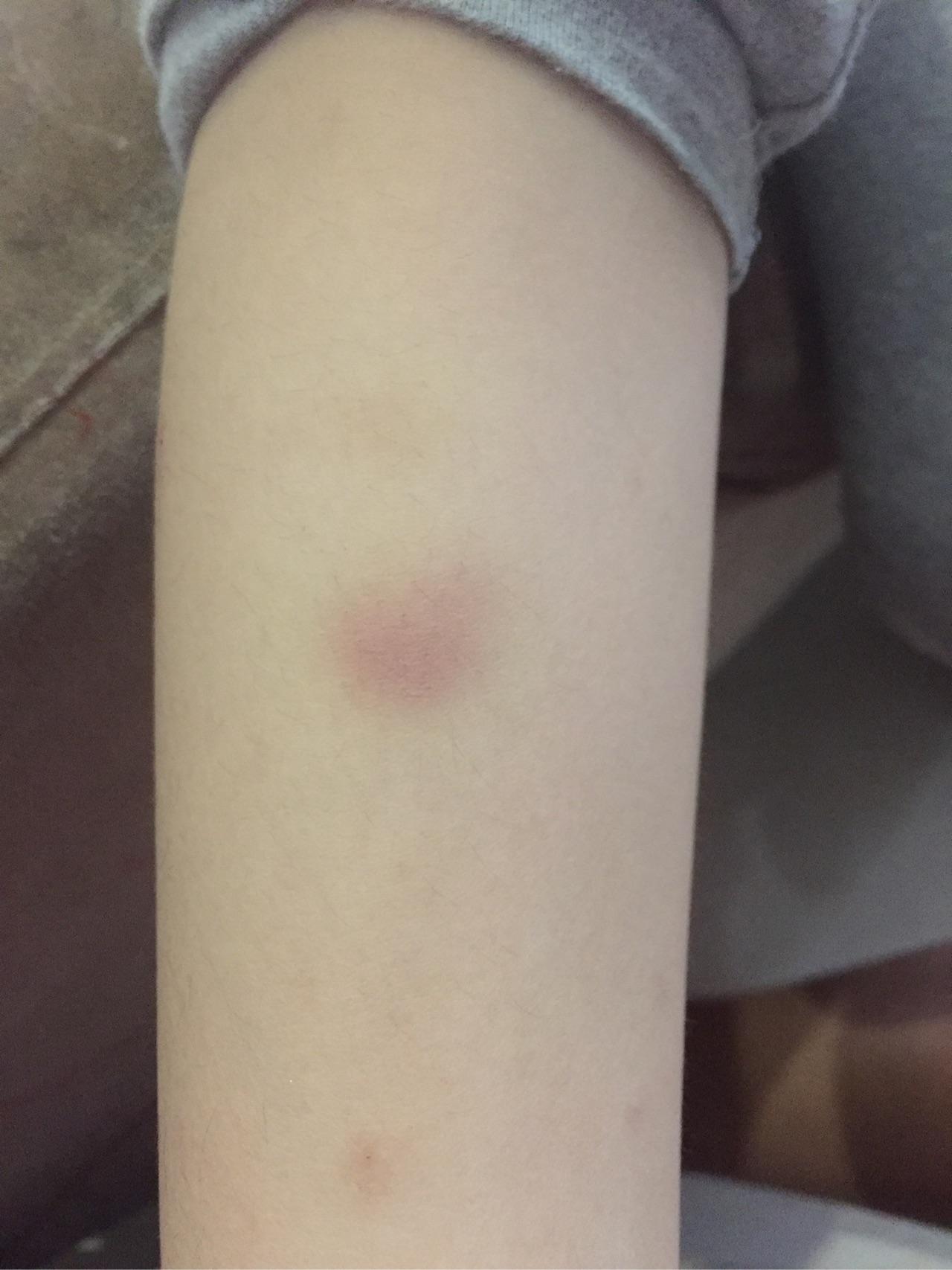 孩子过敏性紫癜红点消失后出现四肢皮肤反复淤青去医院查了尿检血常规