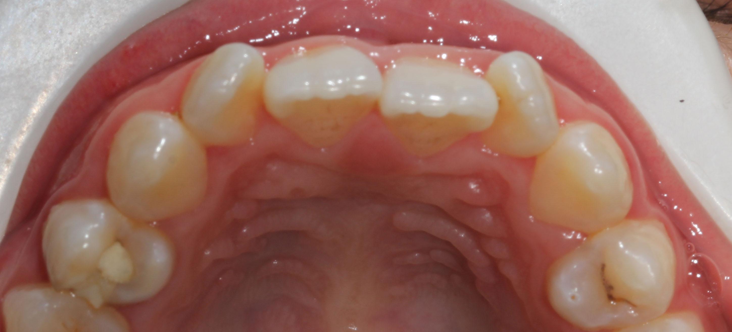 骨性龅牙侧面图片