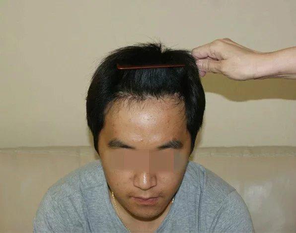 发际线高做植发手术效果是永久的吗?