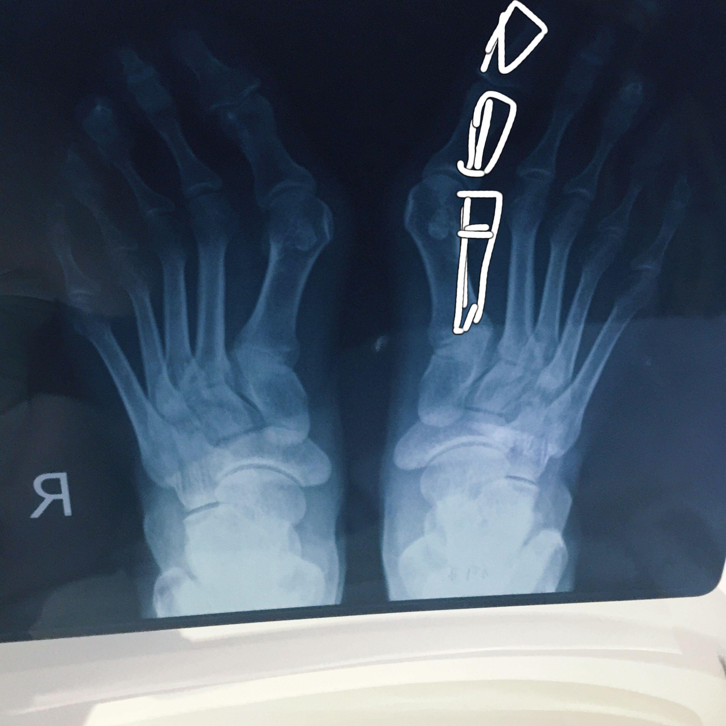 关于拇外翻(大脚骨),动手术好还是不好?困扰好多年了.