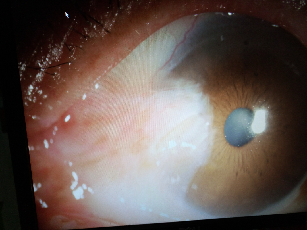 翼状胬肉和睑裂斑不是专业医生怎么可以快速判断?