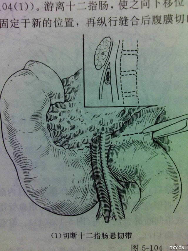 十二指肠淤滞症没有办法根治吗?