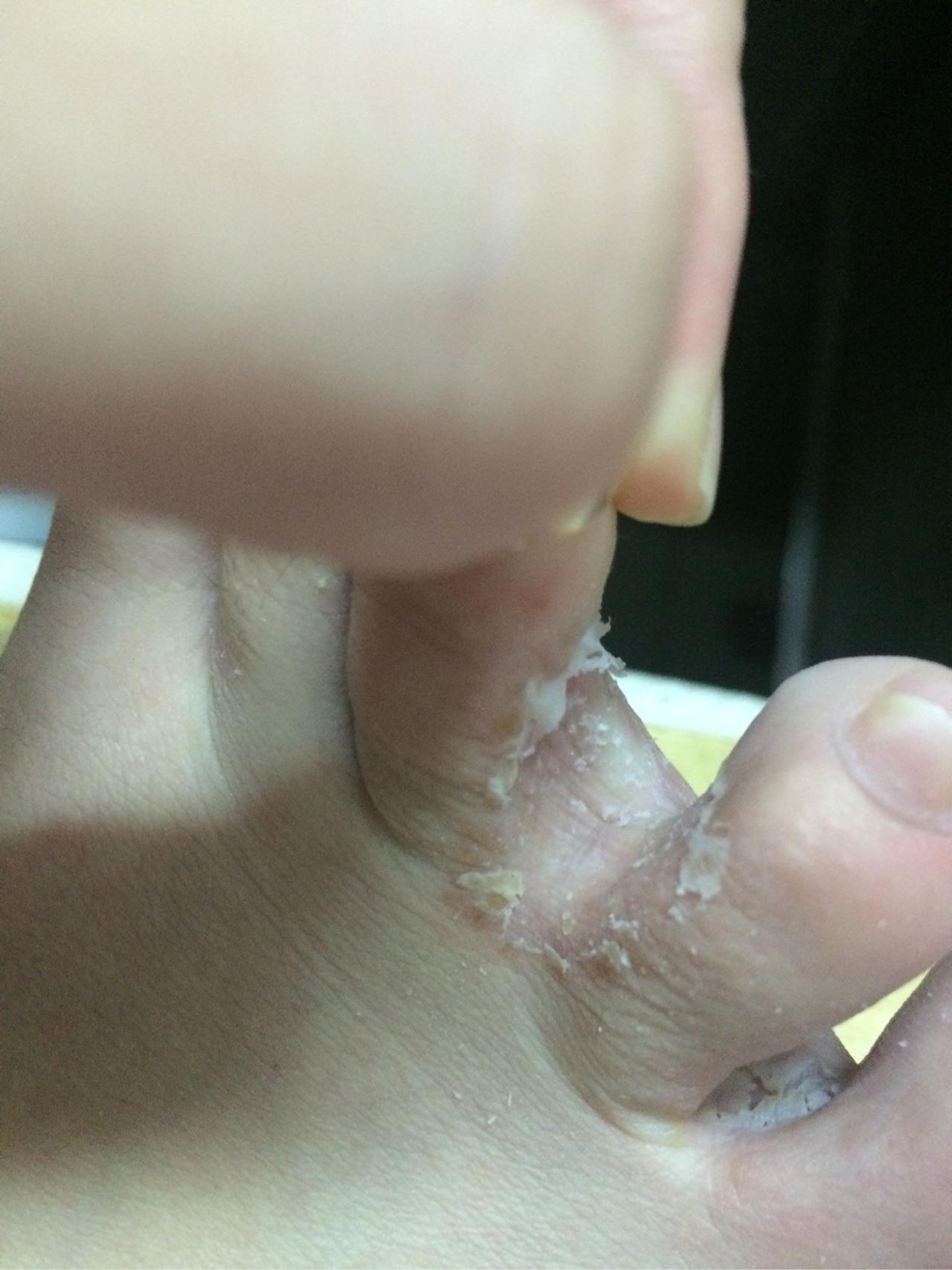 请问这是糜烂型脚气吗