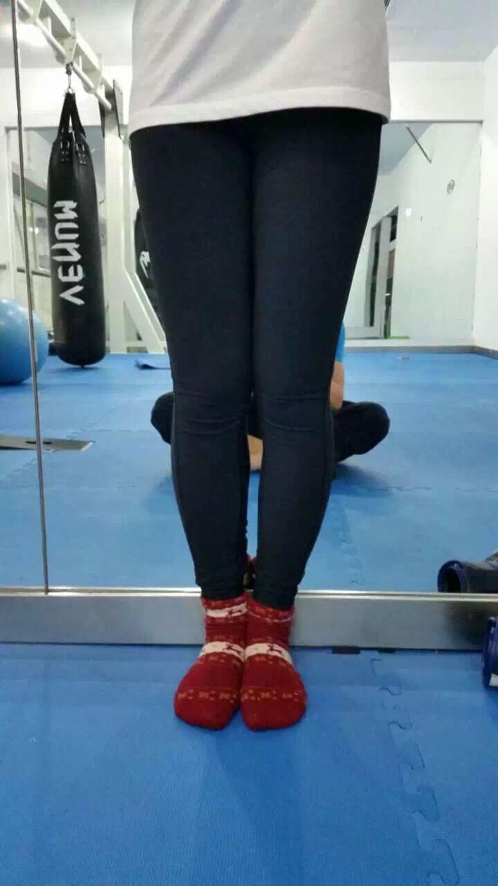 如何矫正罗圈腿o型腿