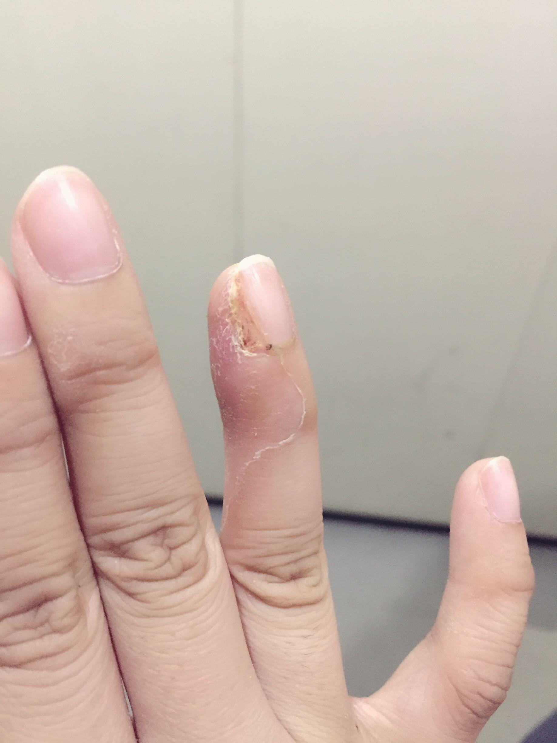 拔指甲是什么样的体验很疼么