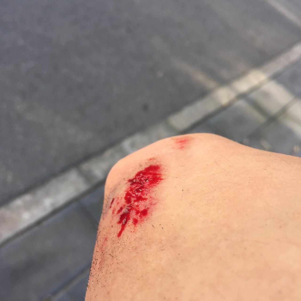 蹭伤,伤口结痂,医生说把结痂撕掉从新长出来的皮肤不会发黑? - 知乎