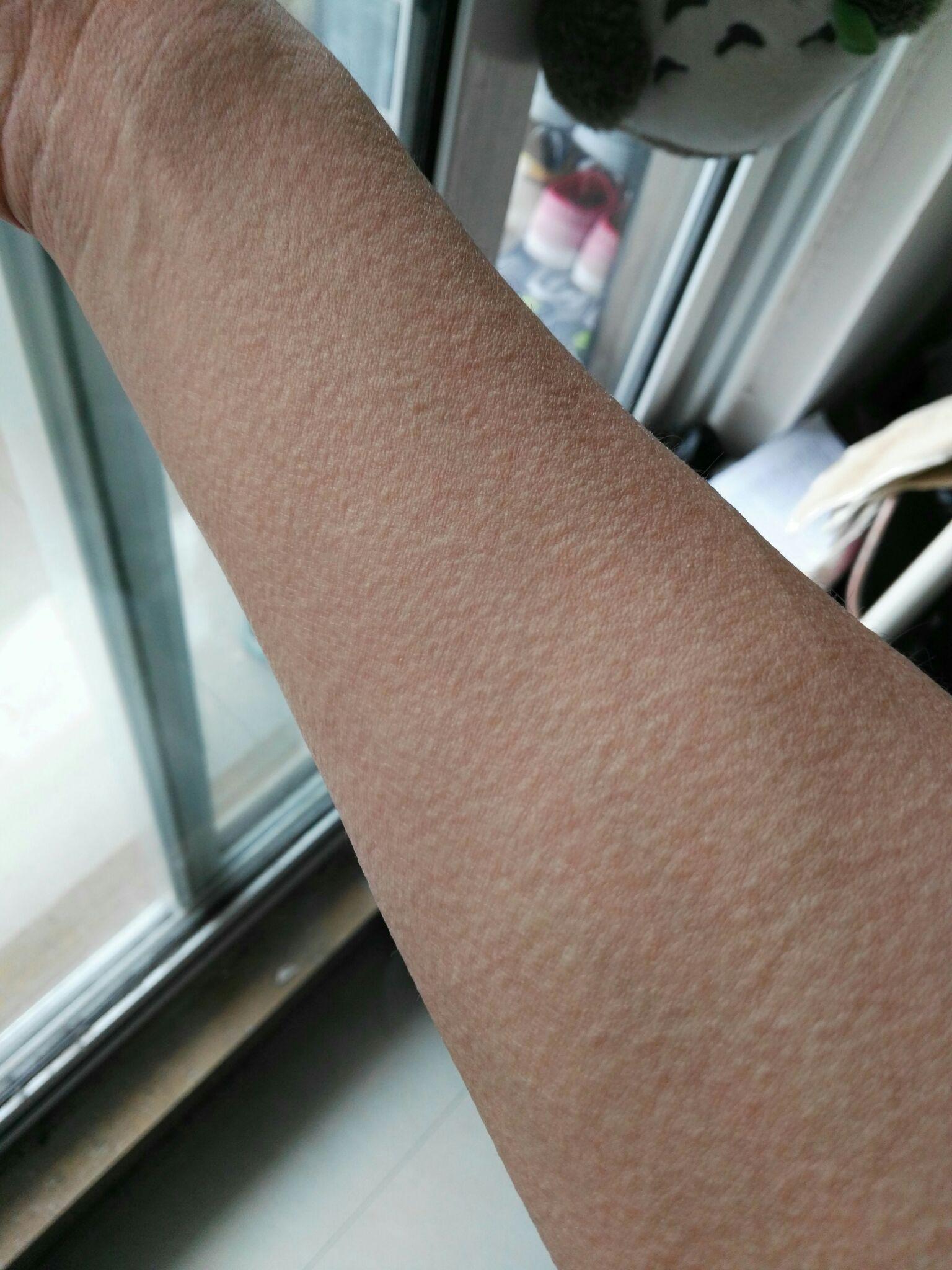 胆碱能性荨麻疹该怎么治疗? - 知乎